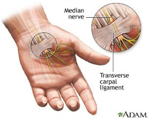 carpal tunnel