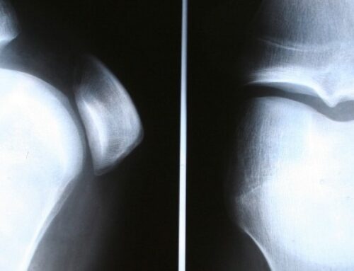 No, running isn’t bad for your knees.